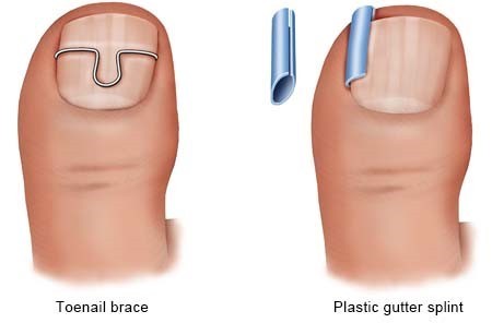 Ingrown nails. What treatments do specialists offer?