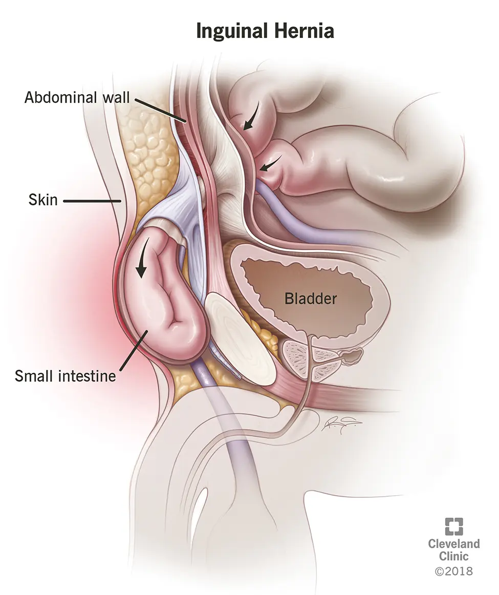 Inguinal hernia &#8211; types, symptoms, treatment, complications [EXPLAINED]