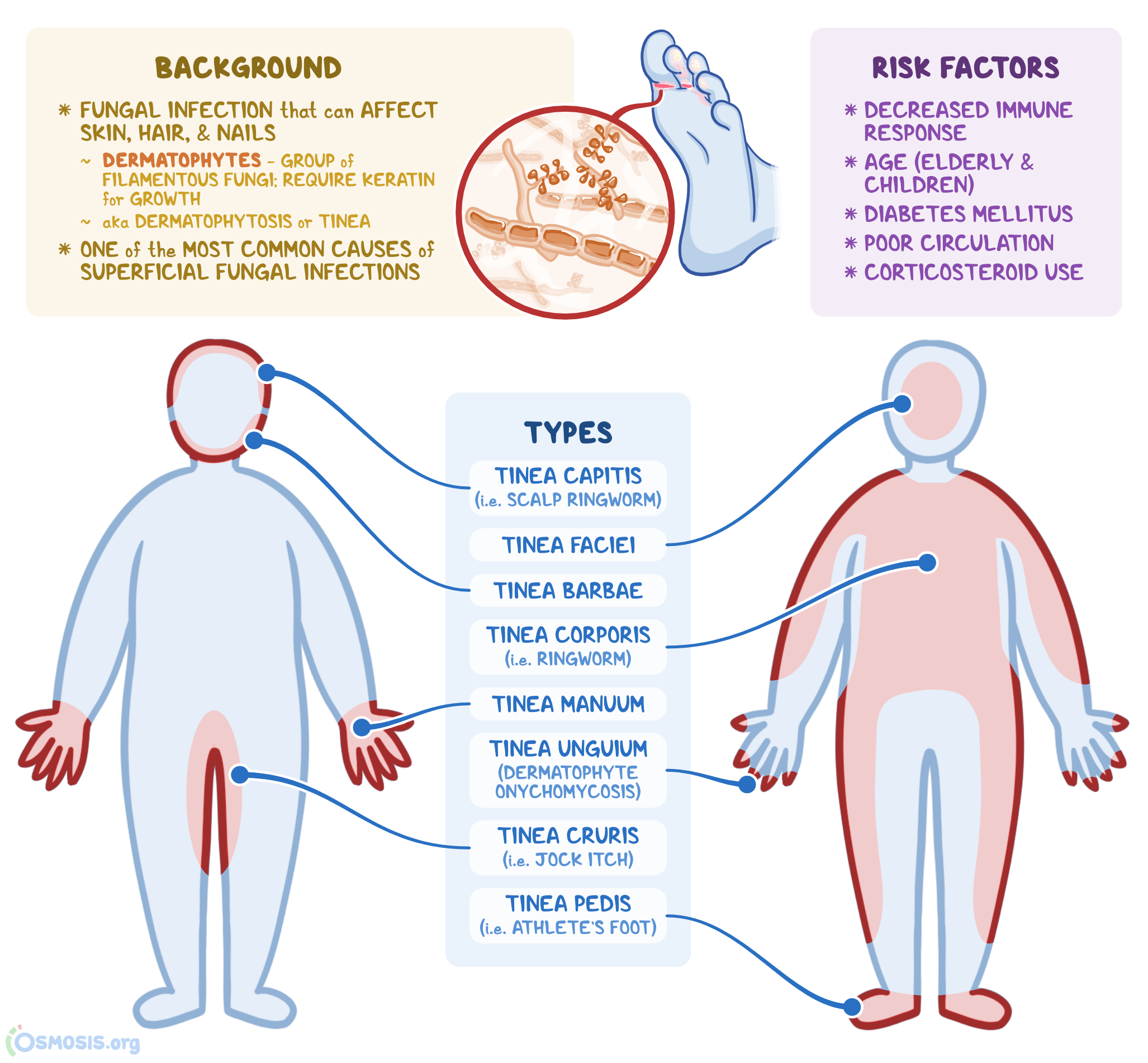 Inguinal Mycosis Causes Symptoms Diagnosis Treatment Prevention Healthy Food Near Me 