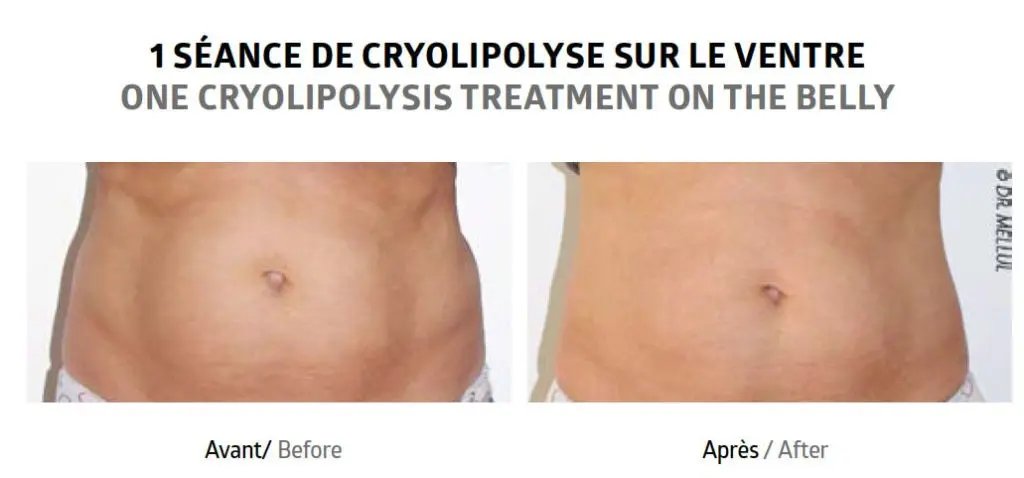 Injection lipolysis