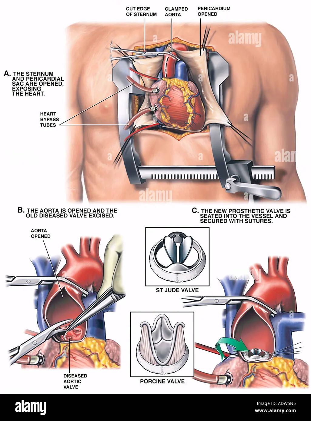 Innovative surgery in Łódź: doctors removed the heart valve from the intestine