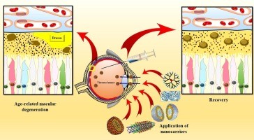 Innovative therapy for patients with exudative AMD