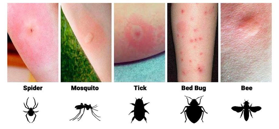 Insect and arachnid bites &#8211; how to deal with them? What should we do if we are bitten by a bee, wasp or tick?