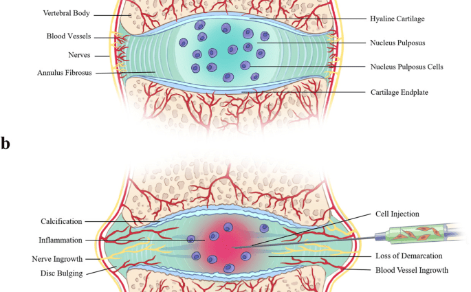 Intervertebral disc cell transplantation is completely safe