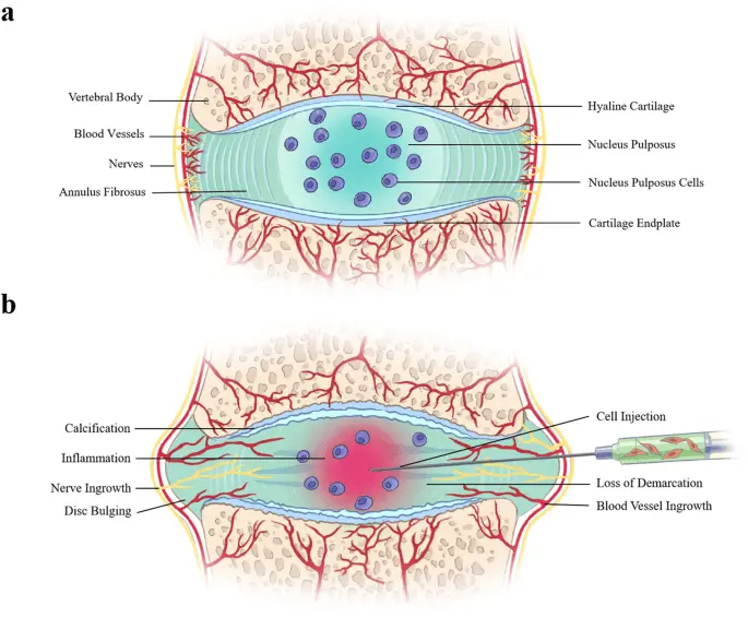 Intervertebral disc cell transplantation is completely safe