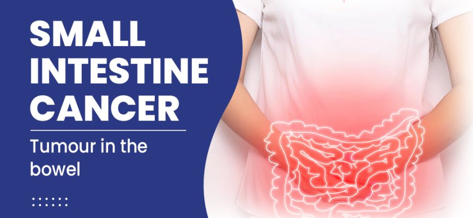 Intestinal cancer &#8211; symptoms, diagnosis and treatment of small and large intestine cancer