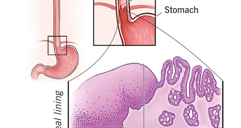 Intestinal metaplasia &#8211; symptoms and treatment