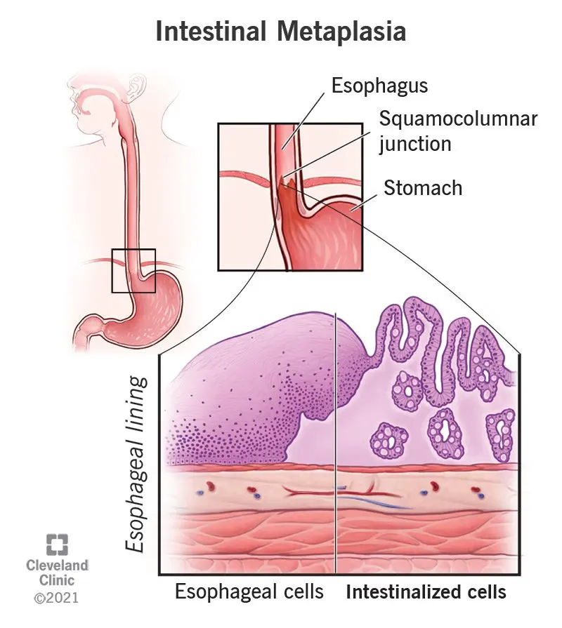 Intestinal metaplasia &#8211; symptoms and treatment