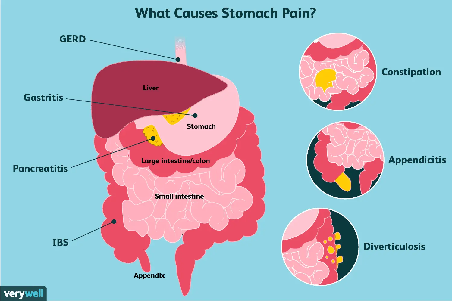 Intestinal pain &#8211; causes, diagnosis and treatment