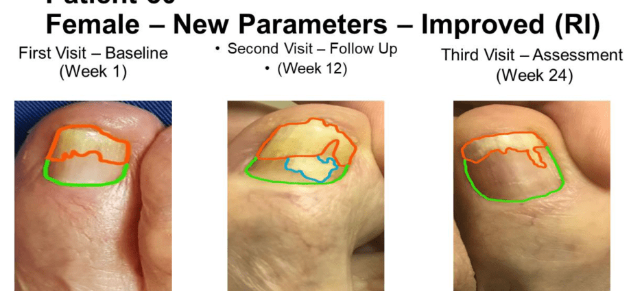 Intra-plaque onychomycosis. How does the disease develop?