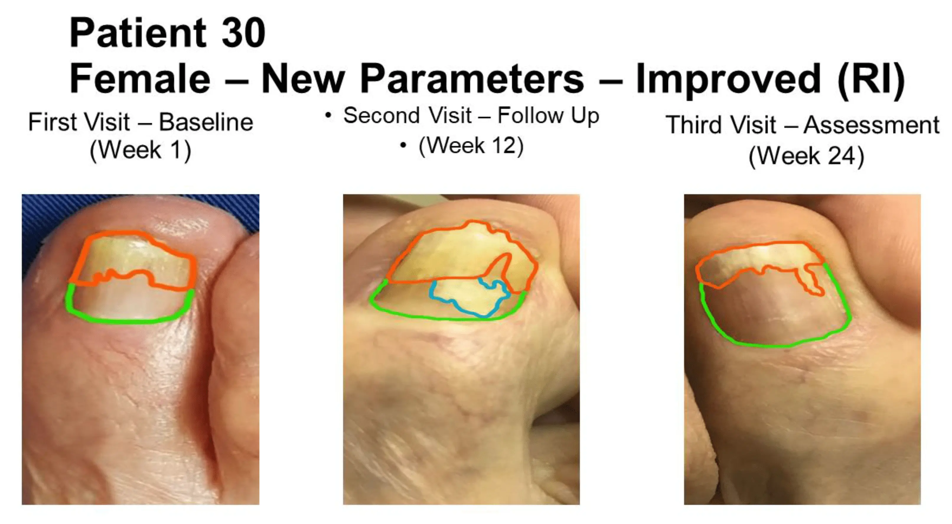 Intra-plaque onychomycosis. How does the disease develop?