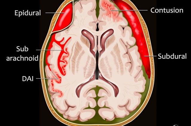 Intracranial hematoma