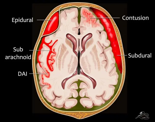 Intracranial hematoma