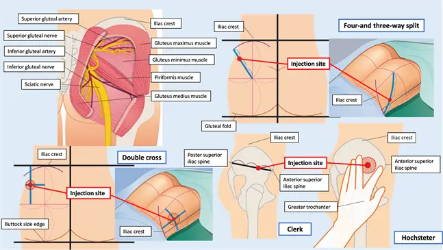 Intramuscular injection &#8211; what is it? Types of injections, method of implementation, possible complications