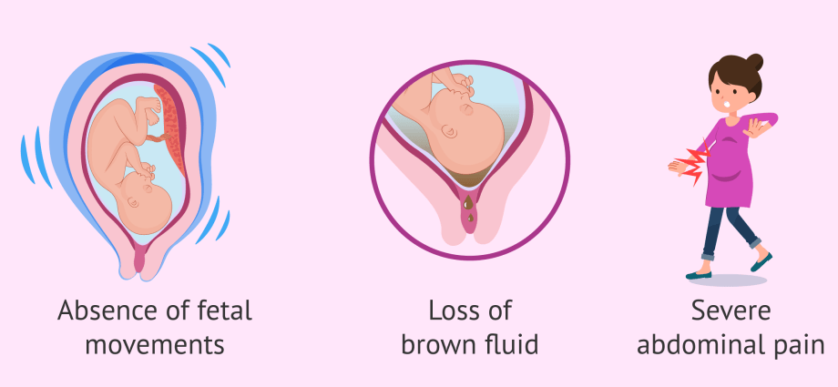 Intrauterine dystrophy of the fetus &#8211; causes and symptoms. How to treat fetal dystrophy?