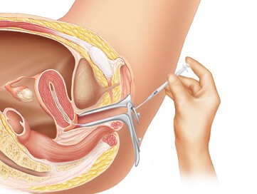 Intrauterine insemination &#8211; what is it?