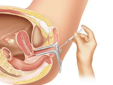 Intrauterine insemination &#8211; what is it?