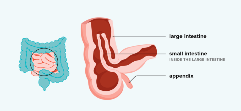 Intussusception &#8211; causes, symptoms, treatment, complications