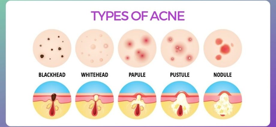 Inverse acne &#8211; characteristics, symptoms and treatment methods