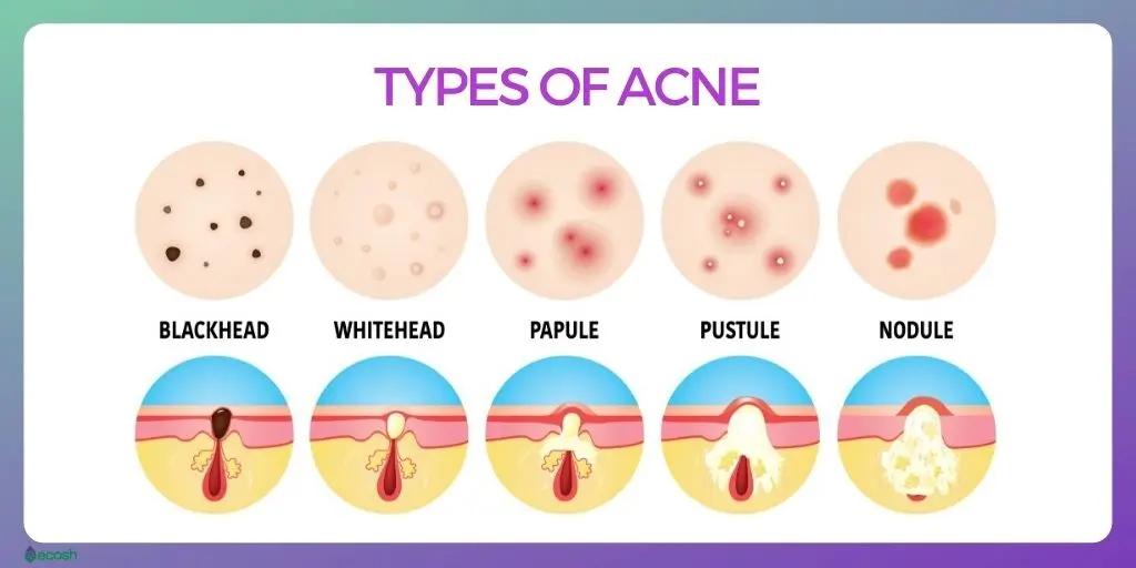 Inverse acne &#8211; characteristics, symptoms and treatment methods