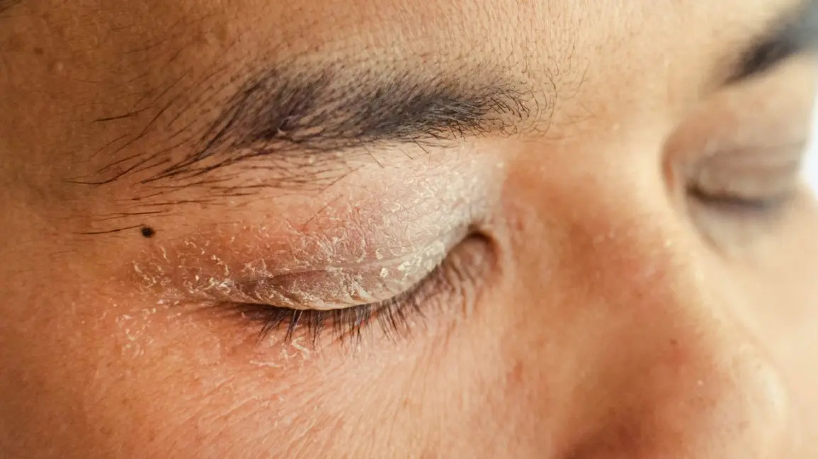 Irritated skin around the eyes. The most common causes of the problem