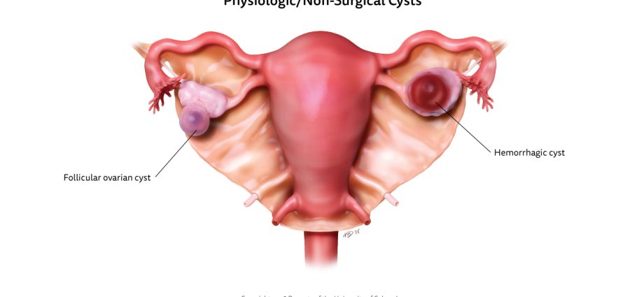 Is a hemorrhagic cyst serious?