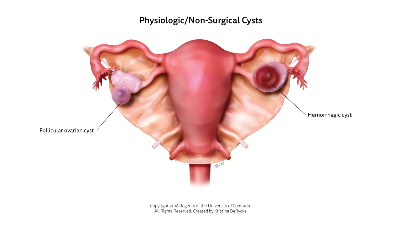 Is a hemorrhagic cyst serious?