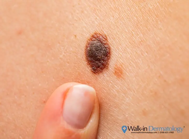 Is a scratched mole dangerous?
