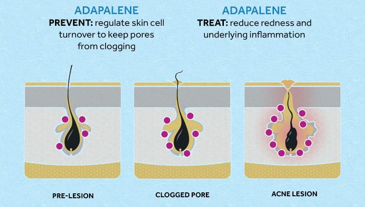 Is Adapalene effective for acne?