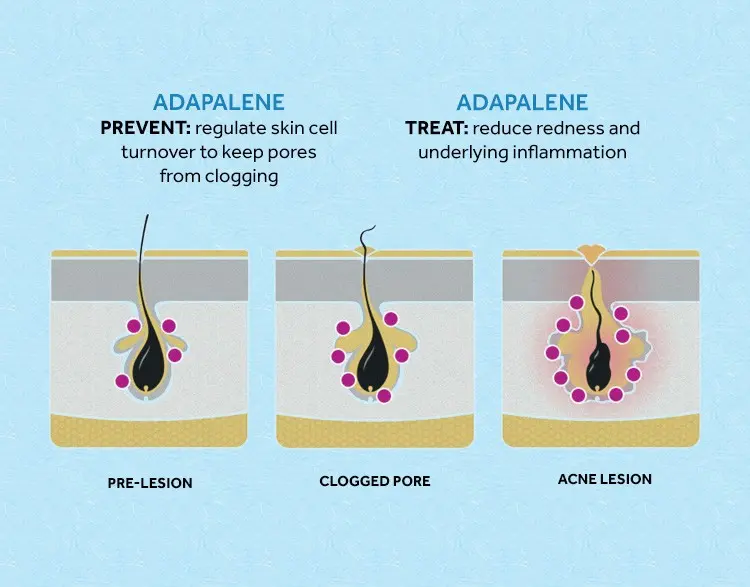 Is Adapalene effective for acne?