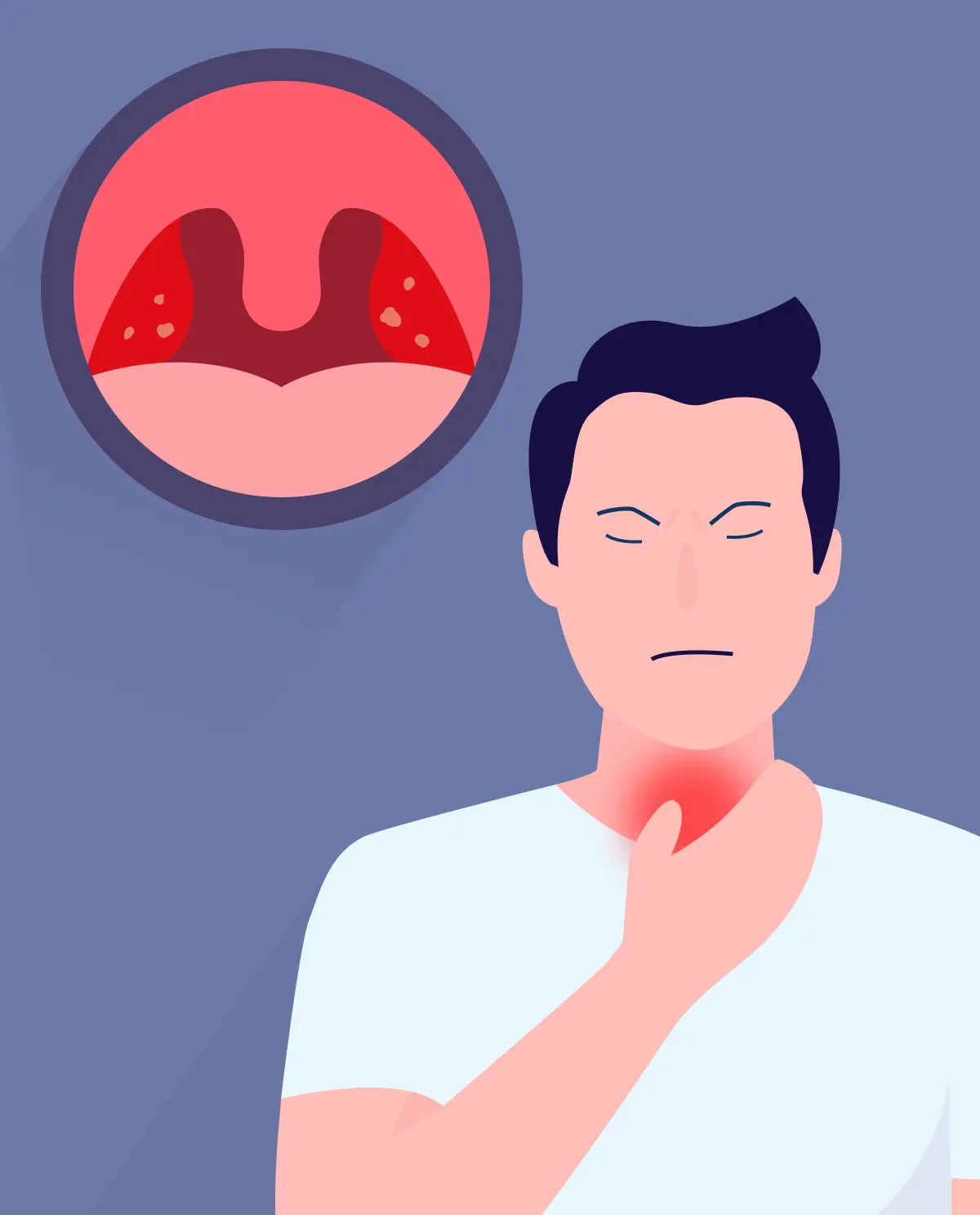 Is angina contagious?