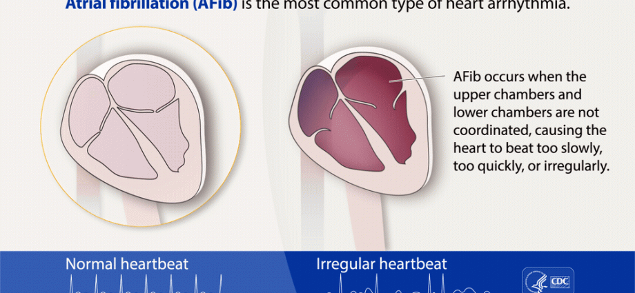 Is atrial fibrillation a lifelong disease?