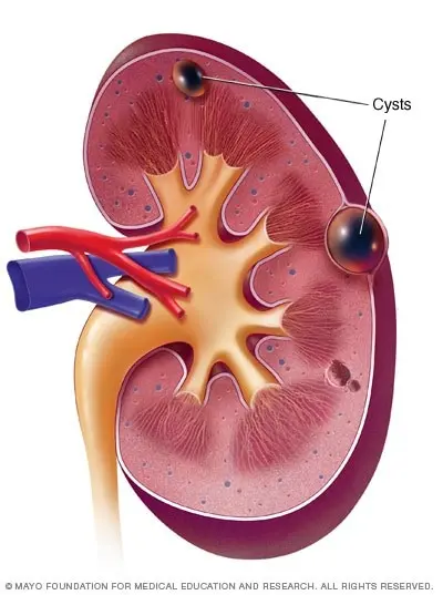 Is cortical kidney cyst harmful to health?