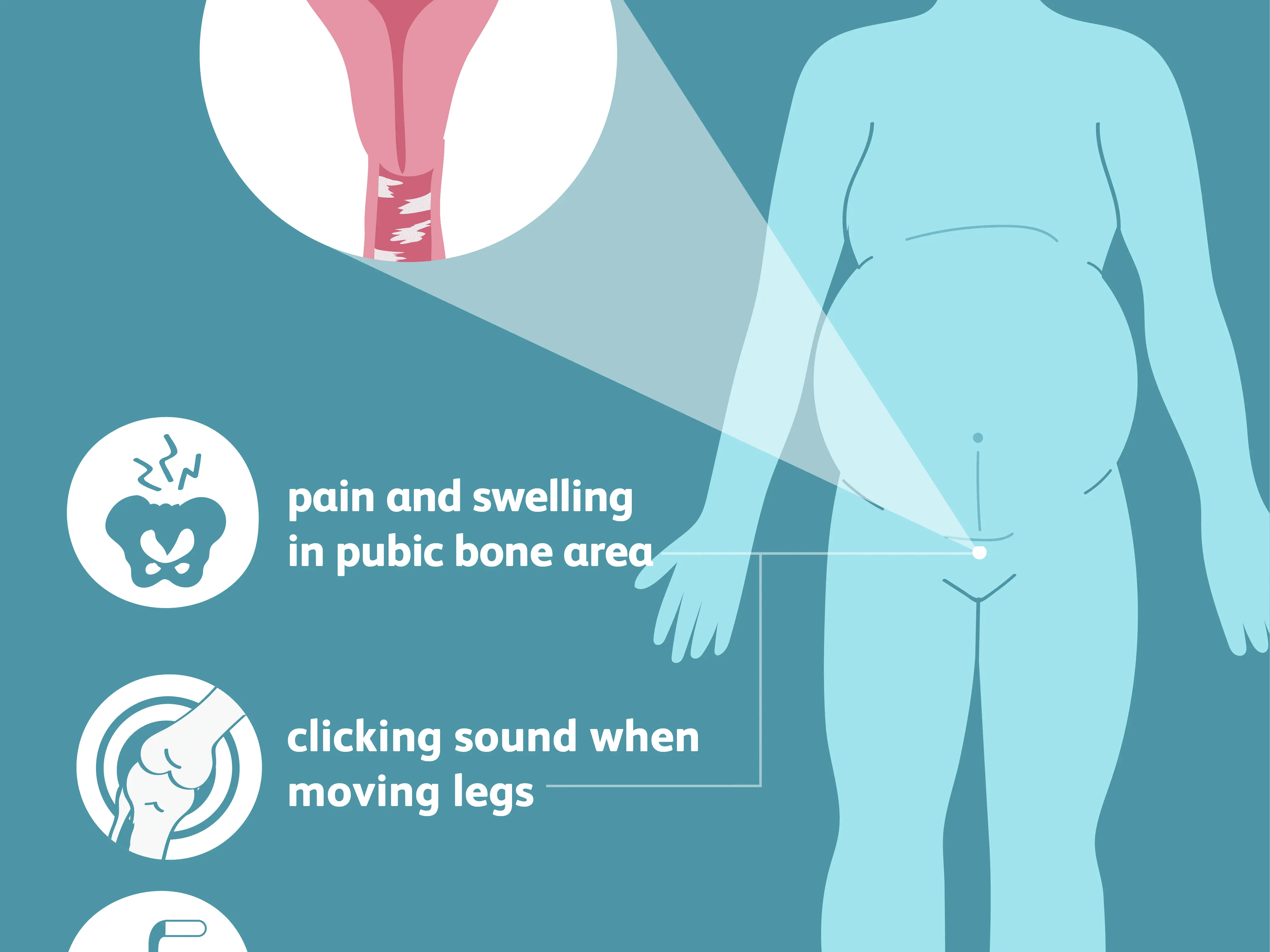 Is groin pain serious in pregnancy?