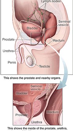 Is it a prostate disease?