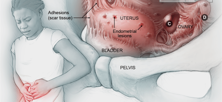 Is it endometriosis? The gynecologist suggests