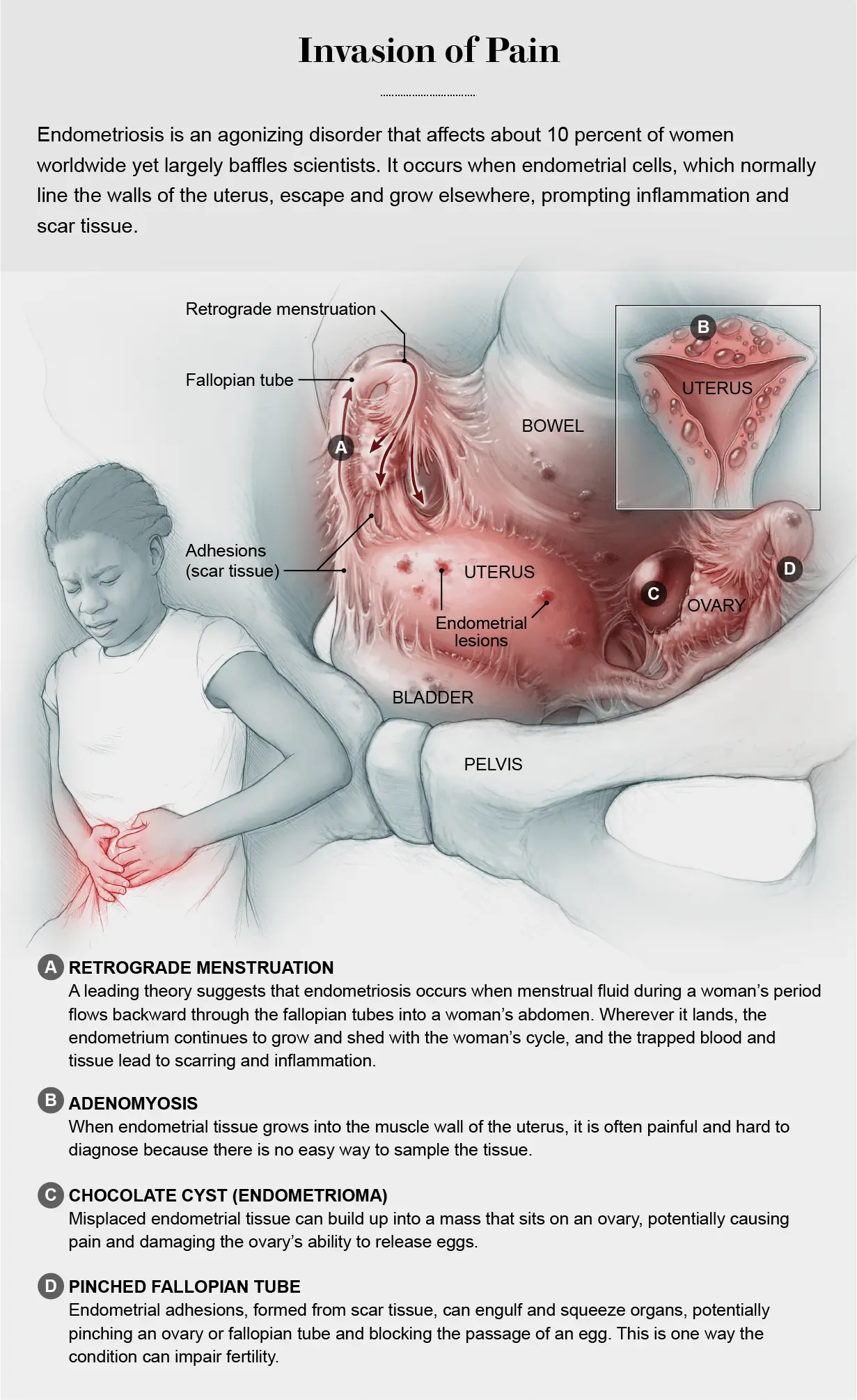 Is it endometriosis? The gynecologist suggests
