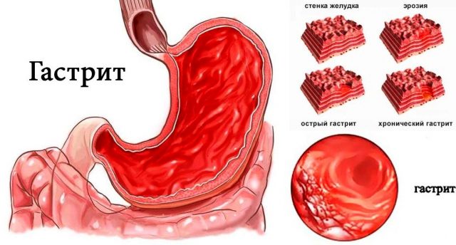 Is it possible to eat pumpkin with gastritis