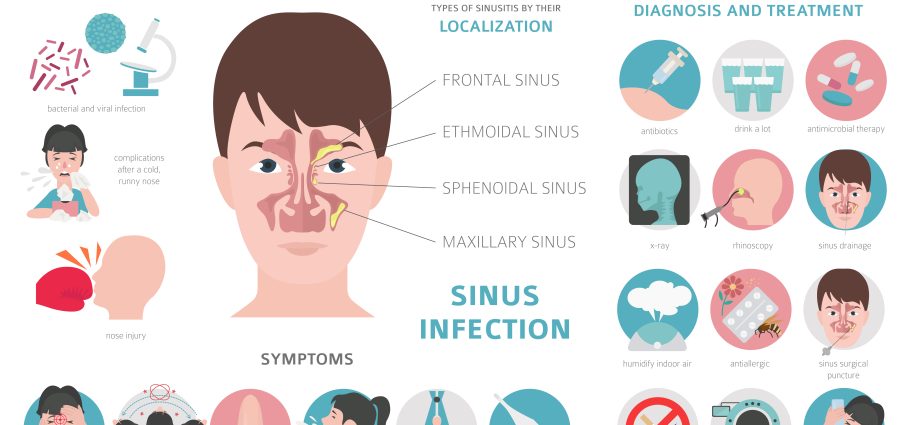 Is it possible to have sinusitis without a runny nose?