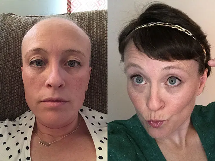 Is it possible to recover hair after chemotherapy and radiotherapy?