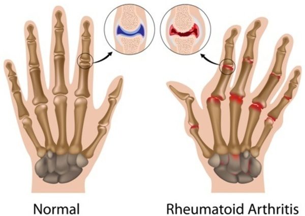 Is rheumatism hereditary?