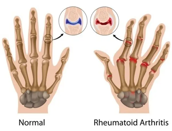 Is rheumatism hereditary?