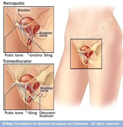 Is surgery necessary for urinary incontinence?