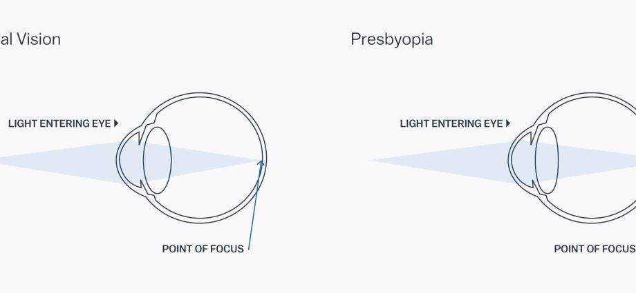 Is the presbyopic doomed to glasses?