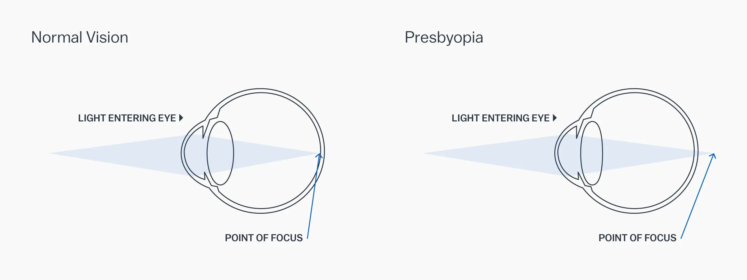 Is the presbyopic doomed to glasses?