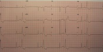 Is the ventricular bigeminy dangerous?