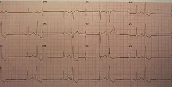 Is the ventricular bigeminy dangerous?