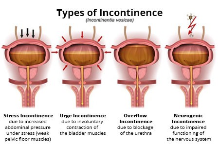 Is this already urinary incontinence?