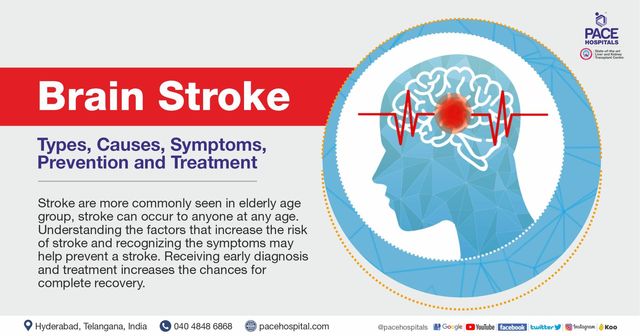 Ischemic stroke &#8211; causes, symptoms, treatment