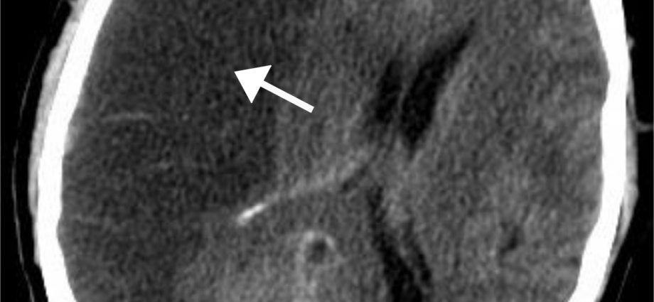 Ischemic stroke of the brain